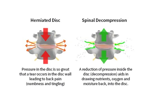 Spinal Decompression