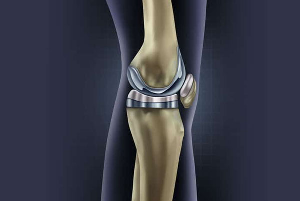 Knee and Hip Arthroplasty