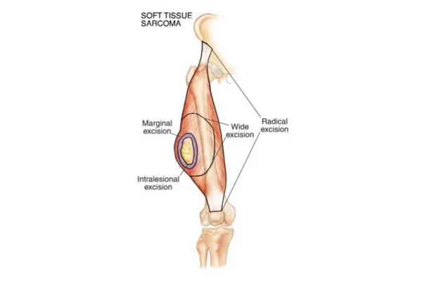 Sarcoma Surgeries