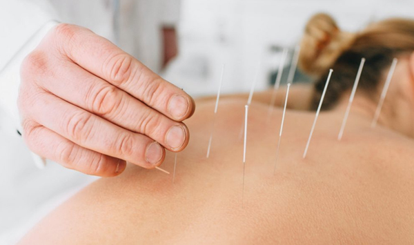 Dry Needling