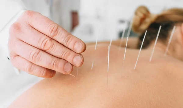 Dry Needling
